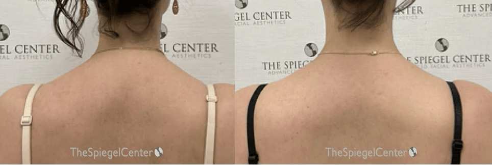 Trapezius Botox (TrapTox) Before & After Gallery - Patient 239580 - Image 1
