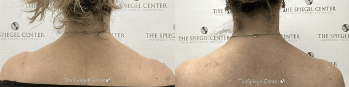 Trapezius Botox (TrapTox) Before & After Gallery - Patient 174426 - Image 1