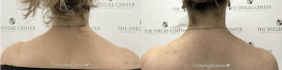 Trapezius Botox (TrapTox) Before & After Gallery - Patient 174426 - Image 1
