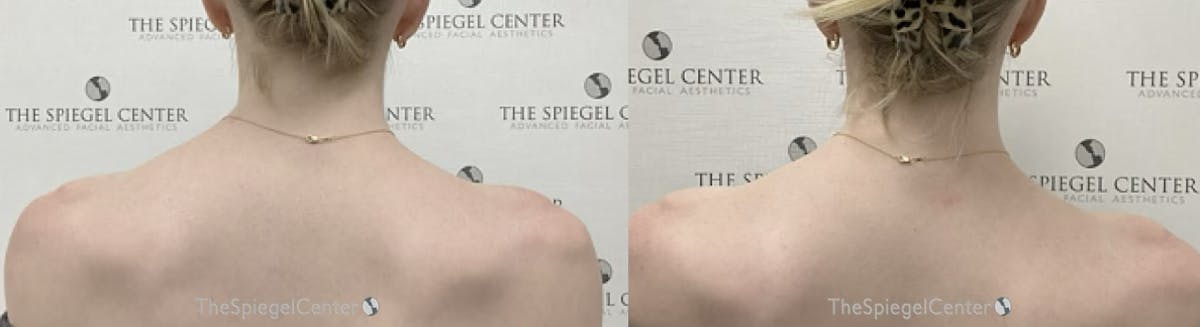 Trapezius Botox (TrapTox) Before & After Gallery - Patient 158101 - Image 1