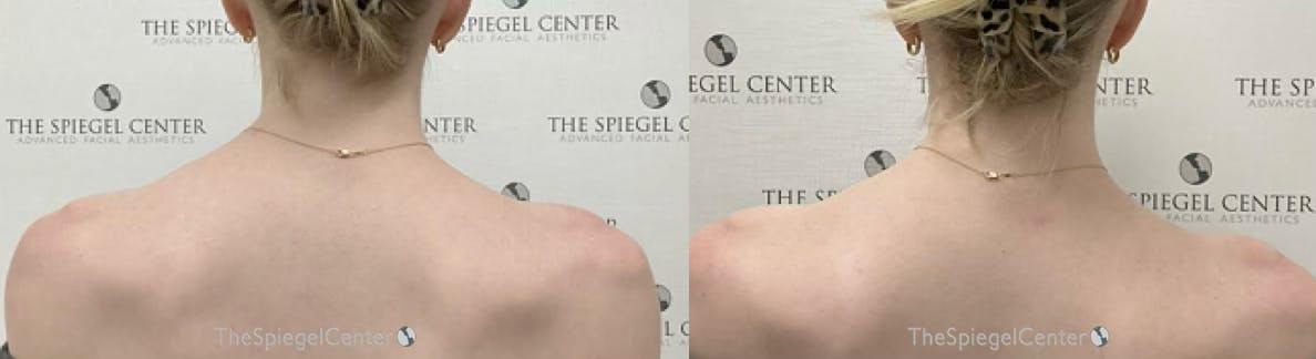 Trapezius Botox (TrapTox) Before & After Gallery - Patient 158101 - Image 1