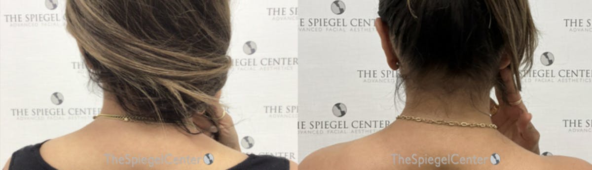 Trapezius Botox (TrapTox) Before & After Gallery - Patient 377336 - Image 1