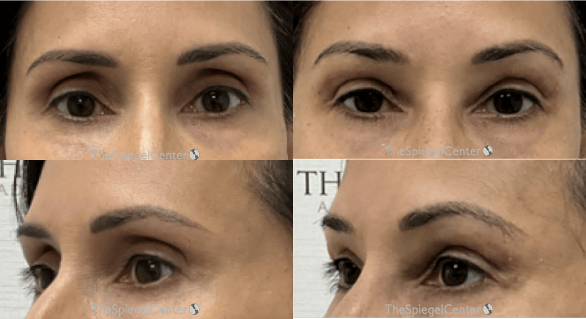 Upper Eyelid Filler Before & After Gallery - Patient 413270 - Image 1