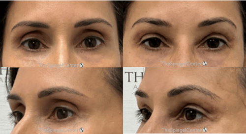 Upper Eyelid Filler Before & After Gallery - Patient 413270 - Image 1