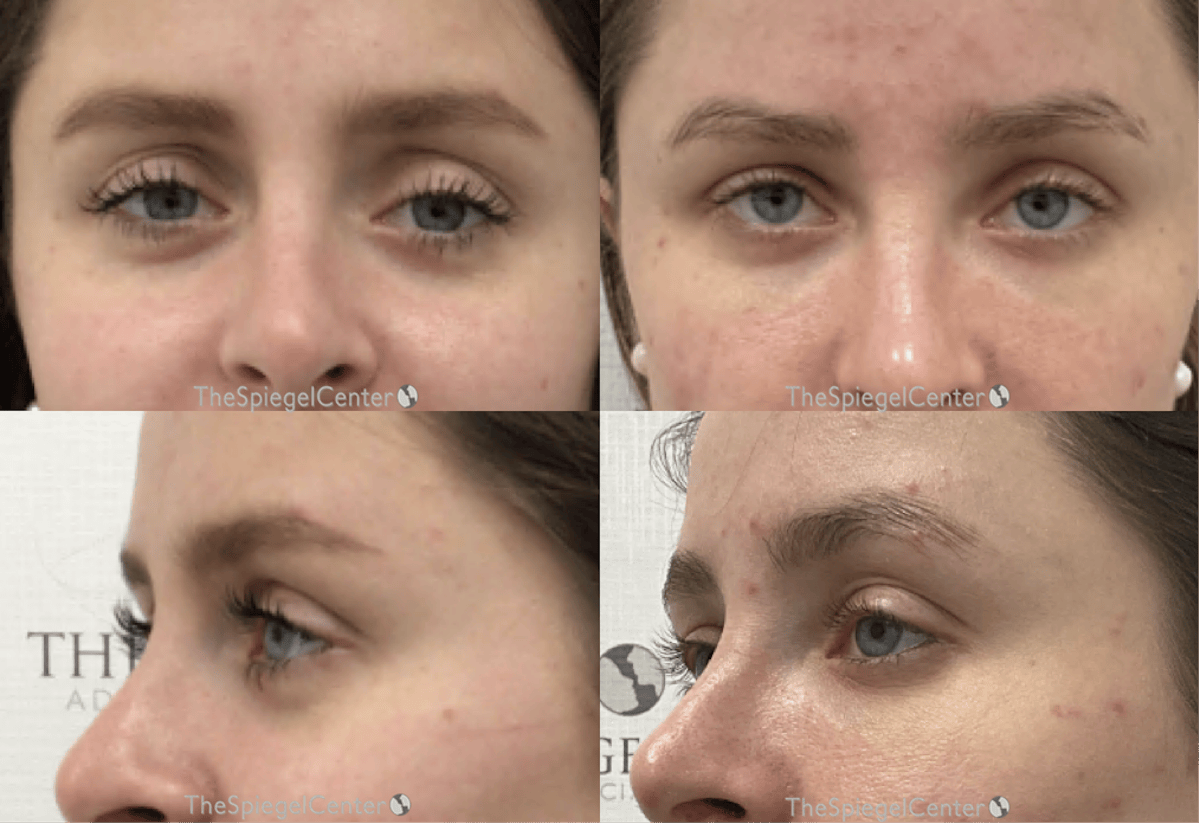 Upper Eyelid Filler Before & After Gallery - Patient 108073 - Image 1