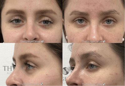 Upper Eyelid Filler Before & After Gallery - Patient 108073 - Image 1