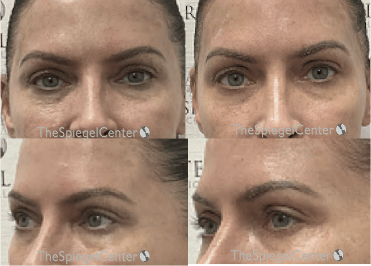 Upper Eyelid Filler Before & After Gallery - Patient 202340 - Image 1