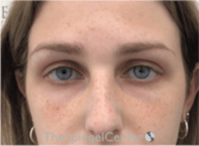 Upper Eyelid Filler Before & After Gallery - Patient 265227 - Image 1