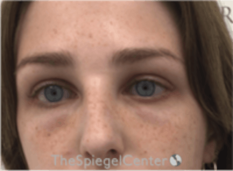 Upper Eyelid Filler Before & After Gallery - Patient 265227 - Image 2