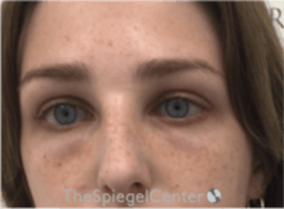 Upper Eyelid Filler Before & After Gallery - Patient 265227 - Image 2