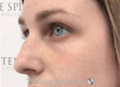 Upper Eyelid Filler Before & After Gallery - Patient 265227 - Image 3