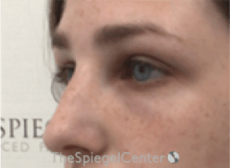 Upper Eyelid Filler Before & After Gallery - Patient 265227 - Image 4