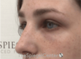 Upper Eyelid Filler Before & After Gallery - Patient 265227 - Image 4