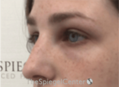 Upper Eyelid Filler Before & After Gallery - Patient 265227 - Image 4
