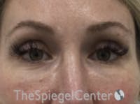 Upper Eyelid Filler Before & After Gallery - Patient 258440 - Image 1