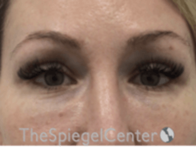 Upper Eyelid Filler Before & After Gallery - Patient 258440 - Image 2