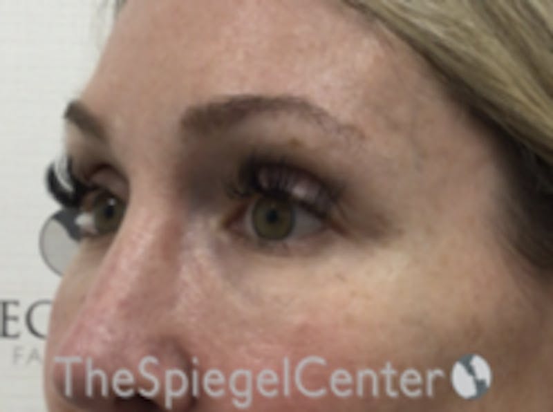 Upper Eyelid Filler Before & After Gallery - Patient 258440 - Image 3