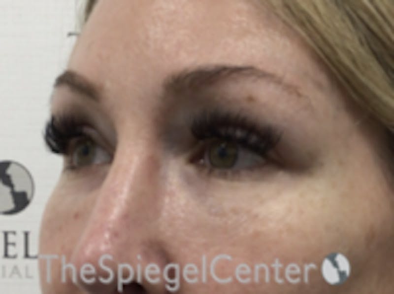 Upper Eyelid Filler Before & After Gallery - Patient 258440 - Image 4
