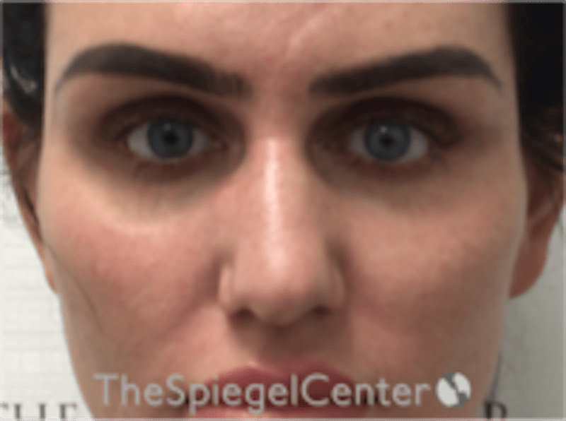 Upper Eyelid Filler Before & After Gallery - Patient 211578 - Image 1