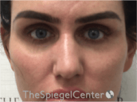 Upper Eyelid Filler Before & After Gallery - Patient 211578 - Image 1