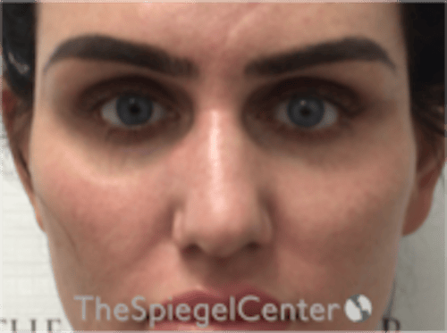 Upper Eyelid Filler Before & After Gallery - Patient 211578 - Image 1