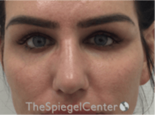 Upper Eyelid Filler Before & After Gallery - Patient 211578 - Image 2