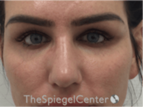 Upper Eyelid Filler Before & After Gallery - Patient 211578 - Image 2