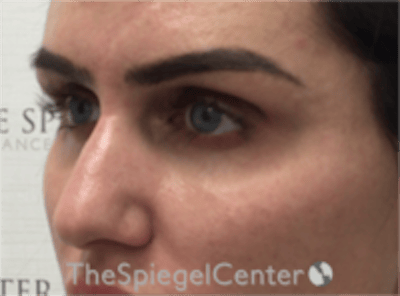 Upper Eyelid Filler Before & After Gallery - Patient 211578 - Image 3