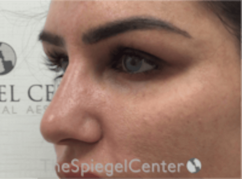 Upper Eyelid Filler Before & After Gallery - Patient 211578 - Image 4
