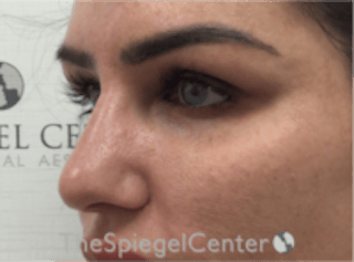 Upper Eyelid Filler Before & After Gallery - Patient 211578 - Image 4