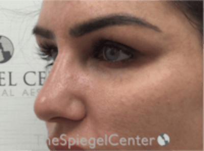 Upper Eyelid Filler Before & After Gallery - Patient 211578 - Image 4