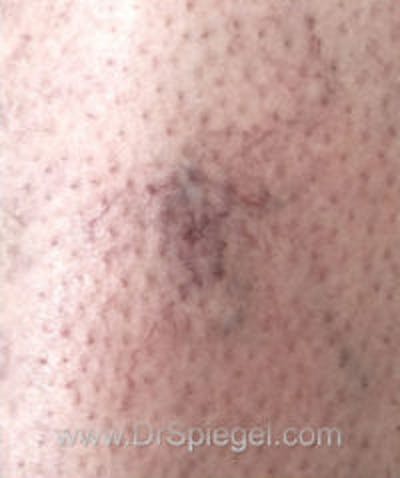 Vein Laser Before & After Gallery - Patient 287264 - Image 1