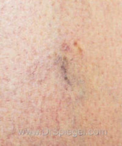Vein Laser Before & After Gallery - Patient 287264 - Image 2