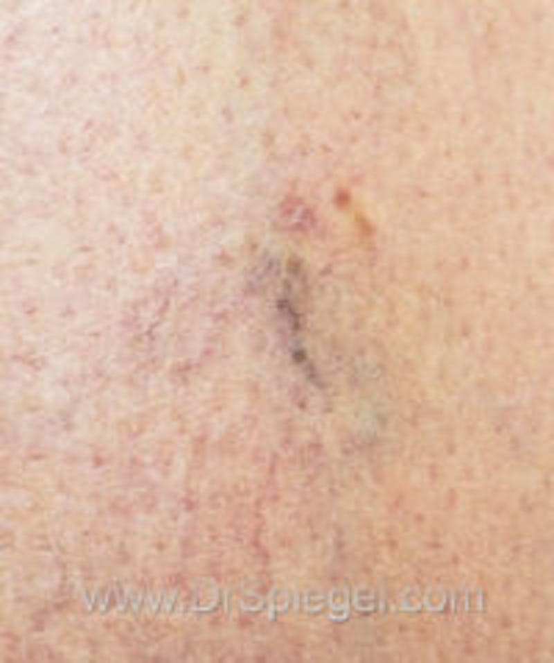 Vein Laser Before & After Gallery - Patient 287264 - Image 2