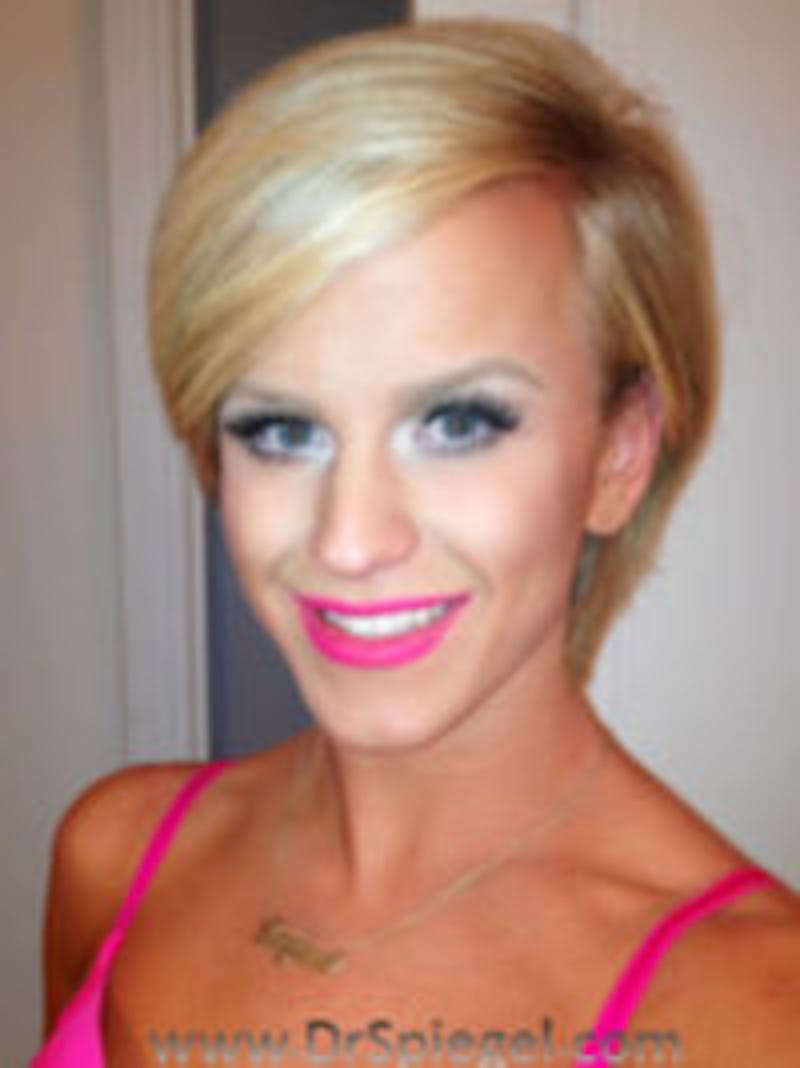 FFS Before & After Gallery - Patient 414773 - Image 1