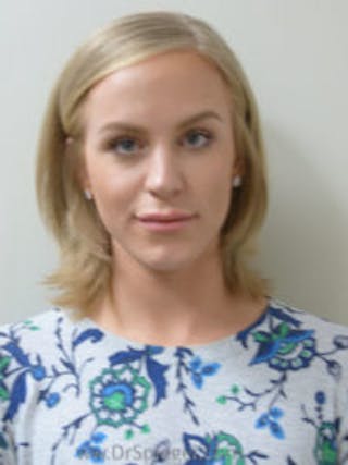 FFS Before & After Gallery - Patient 414773 - Image 2