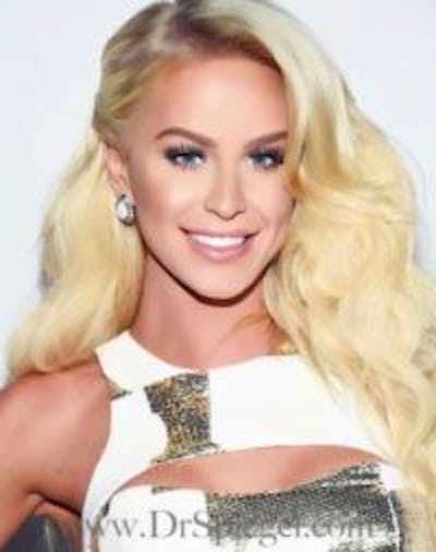 FFS Before & After Gallery - Patient 414773 - Image 4