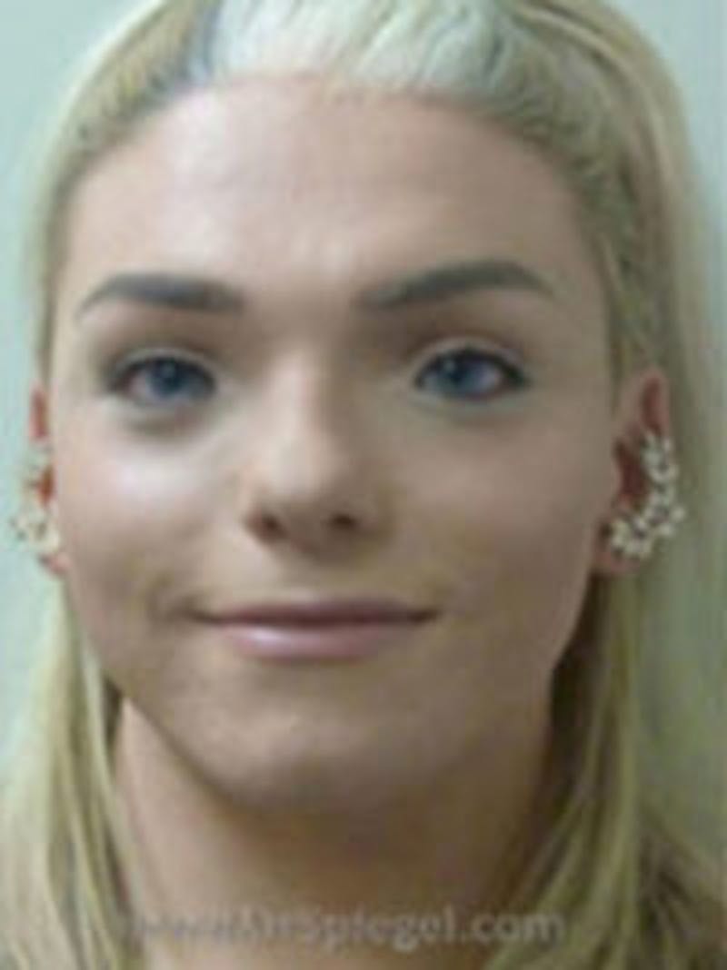 FFS Before & After Gallery - Patient 398053 - Image 1