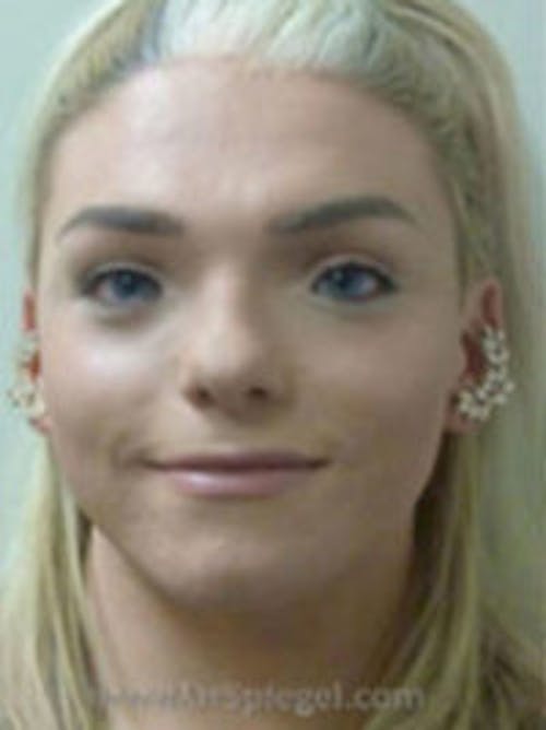 FFS Before & After Gallery - Patient 398053 - Image 1