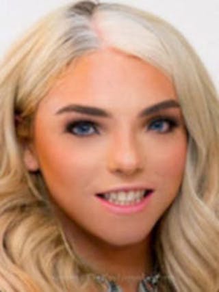 FFS Before & After Gallery - Patient 398053 - Image 2