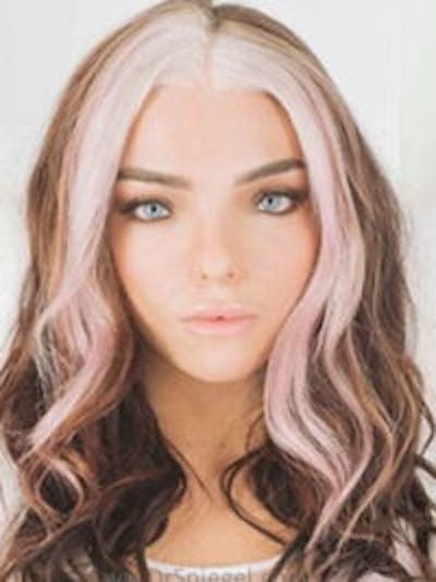 FFS Before & After Gallery - Patient 398053 - Image 3