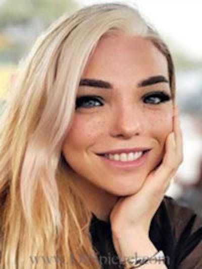 FFS Before & After Gallery - Patient 398053 - Image 4