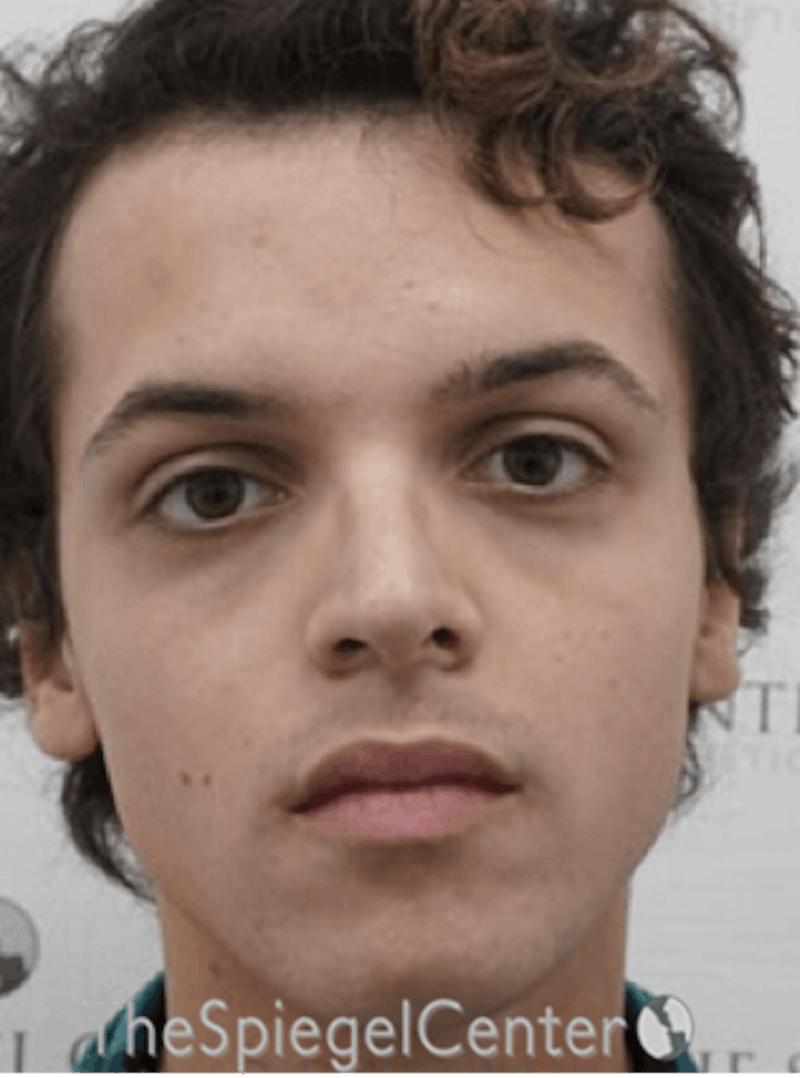 FFS Before & After Gallery - Patient 365606 - Image 1