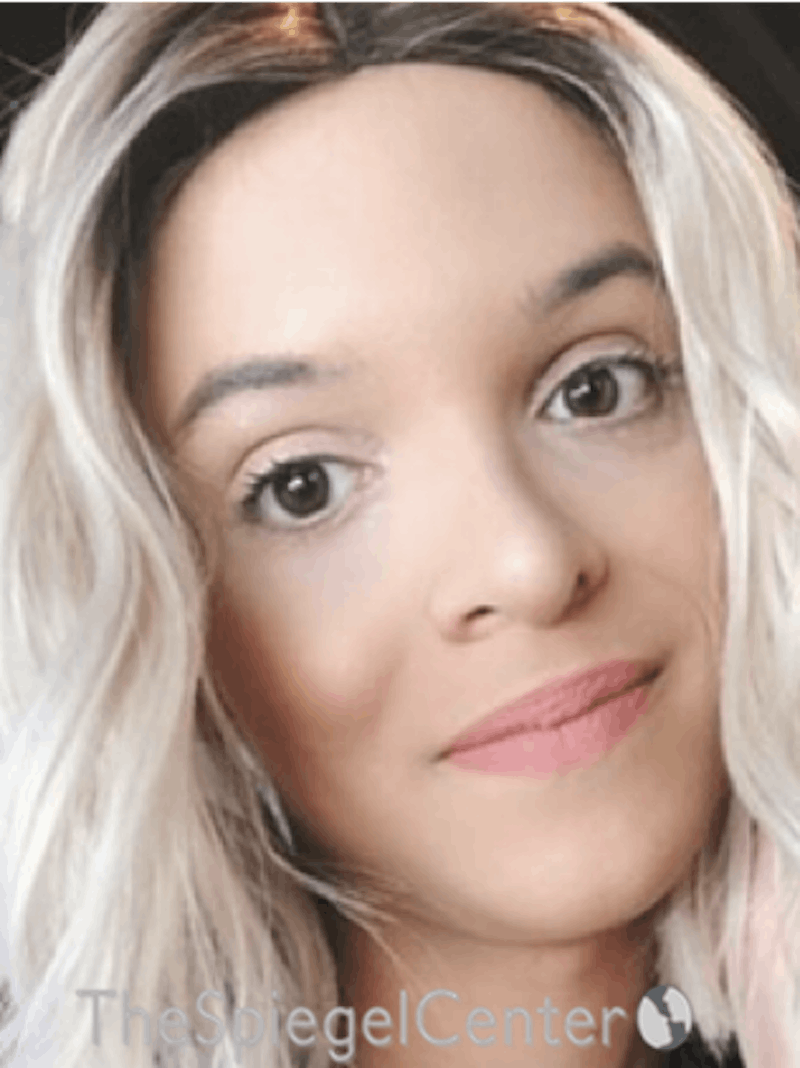 FFS Before & After Gallery - Patient 365606 - Image 2