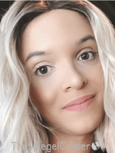 FFS Before & After Gallery - Patient 365606 - Image 2