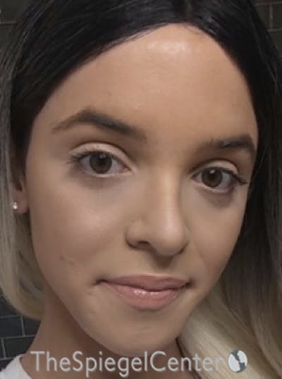 FFS Before & After Gallery - Patient 365606 - Image 3