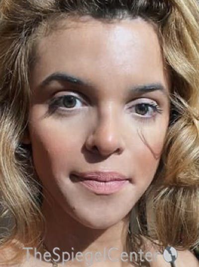 FFS Before & After Gallery - Patient 365606 - Image 4