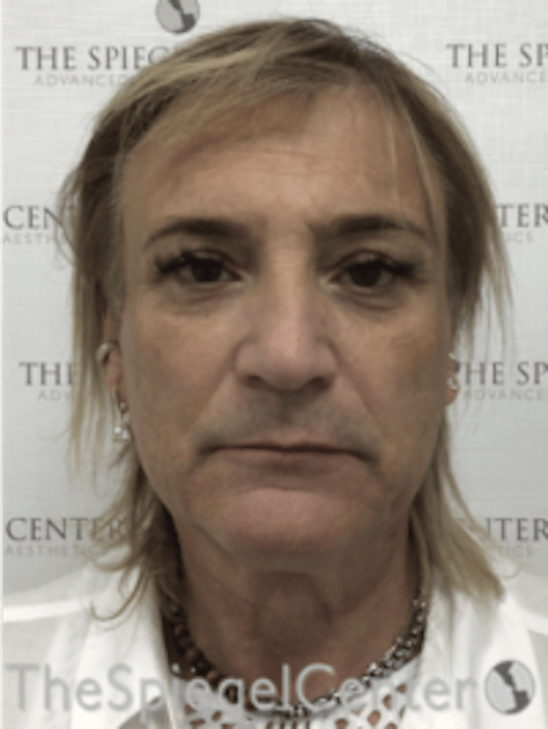FFS Before & After Gallery - Patient 116267 - Image 1