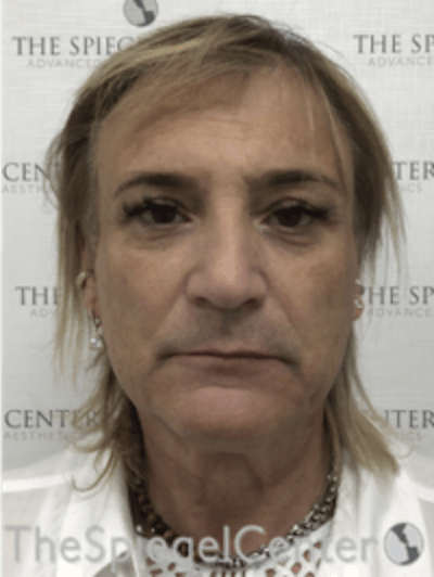 FFS Before & After Gallery - Patient 116267 - Image 1