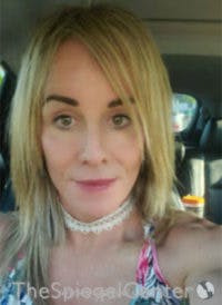 FFS Before & After Gallery - Patient 326560 - Image 3